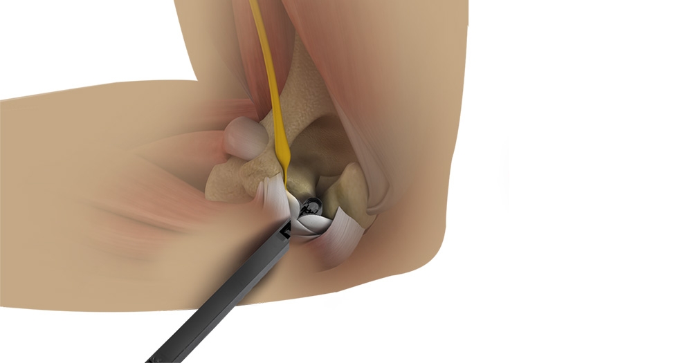 Endoscopic cubital tunnel release