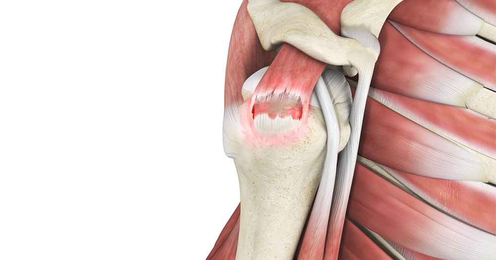 Signs of a Torn Rotator Cuff