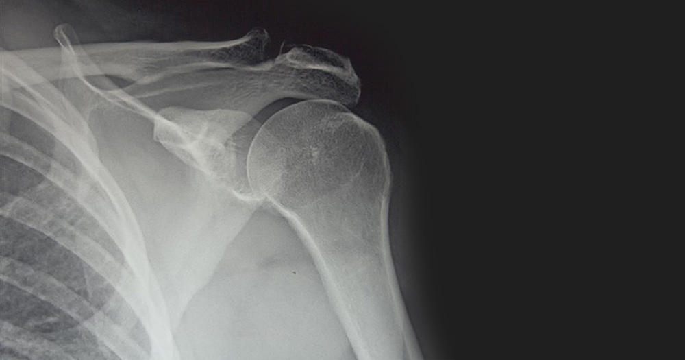 Will a Hairline Fracture Heal on Its Own?
